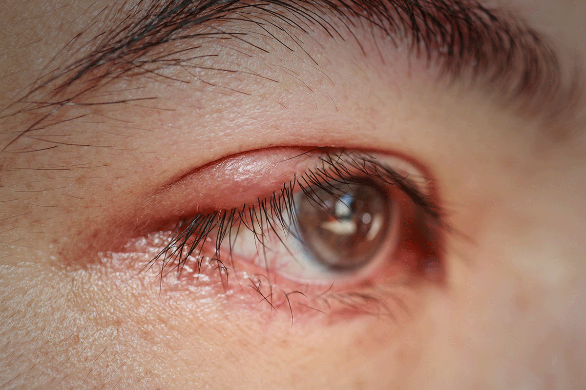 Como a blefarite afeta os olhos – Donato Hospital de Olhos