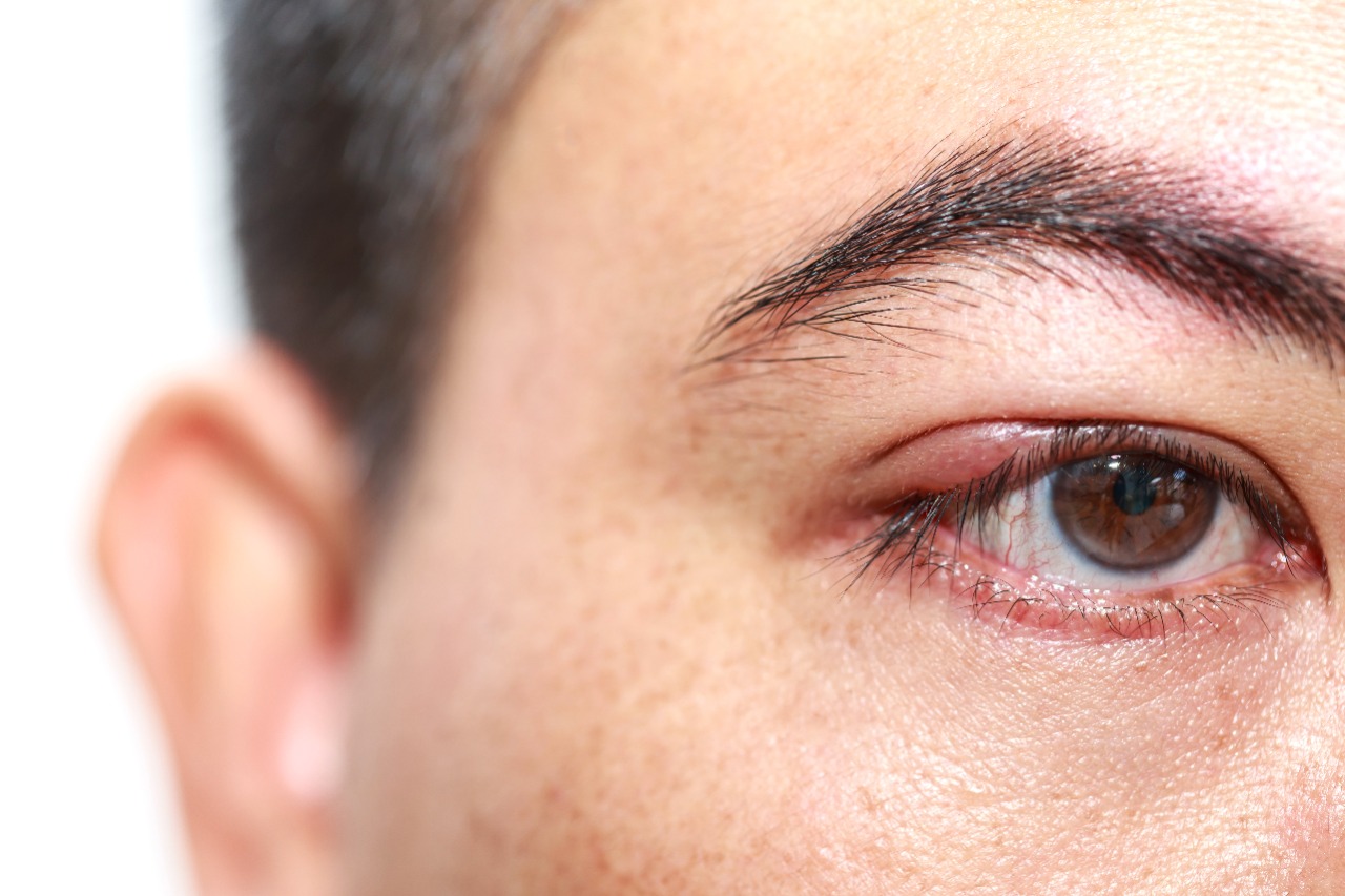 Clínica de olhos Levate - 👀 Terçol ou Hordéolo: 1. O que é? Pequeno nódulo  infeccioso na região palpebral, mais precisamente na base dos cílios.  Geralmente ocorre por uma obstrução das glândulas